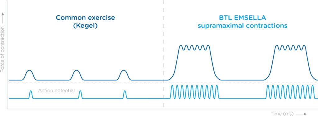 EMSELLA chair treatment for incontinence and sexual dysfunction