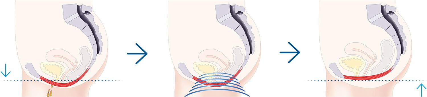EMSELLA chair treatment for incontinence and sexual dysfunction